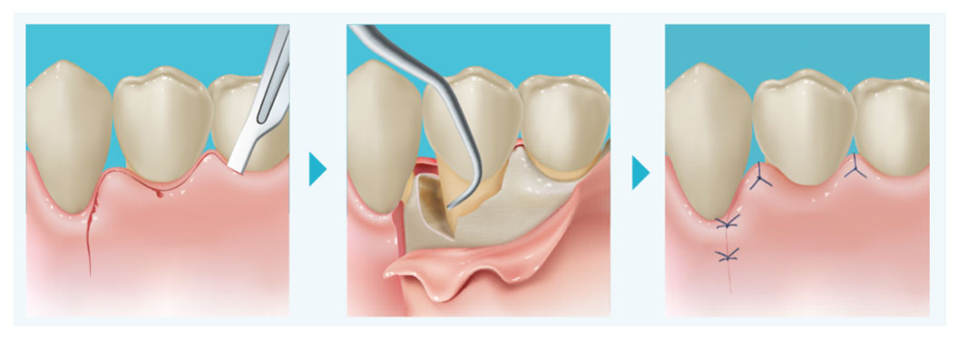 歯周外科治療