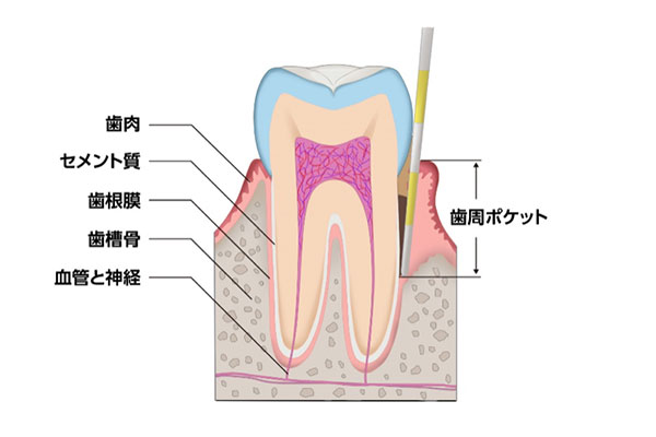 歯周ポケット検査